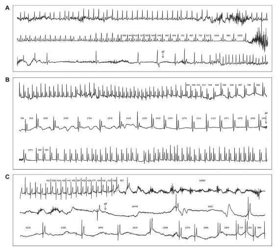 Electrocardiogram recorded during a syncopal episode in an 8 year old male Boxer