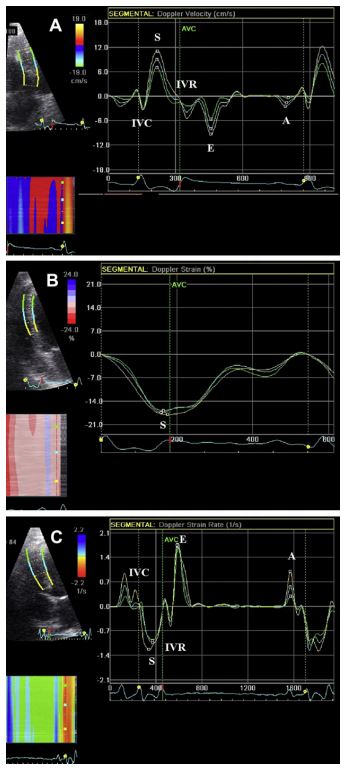 Examples of septal longitudinal tissue Doppler imaging curves of a healthy Doberman Pinscher obtained from left apical four chamber view