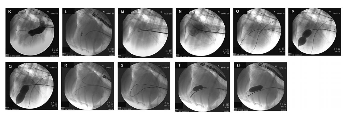 Fluoroscopic and angiographic images from 2 dogs with severe congenital mitral valve stenosis that underwent cardiac catheterization and balloon valvuloplasty