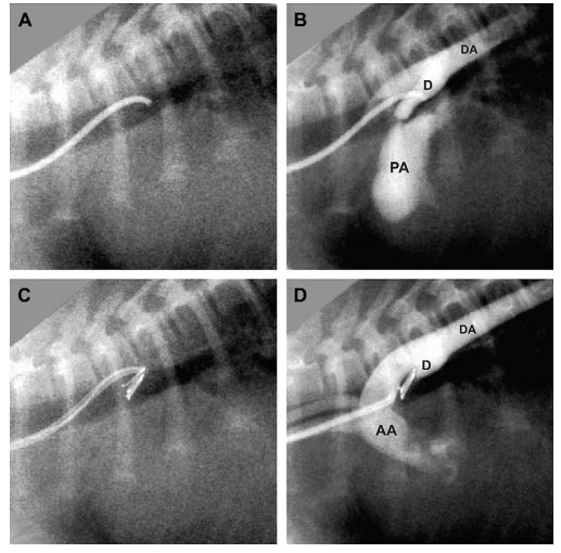 Fluoroscopic images from a dog with patent ductus arteriosus during coil embolization via the carotid artery