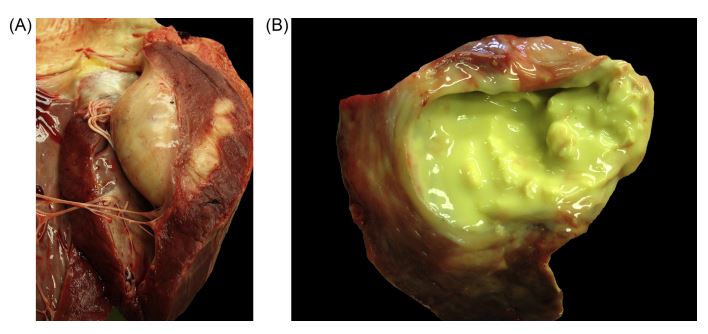 Gross pathology images of the heart from a cow with myocardial abscess