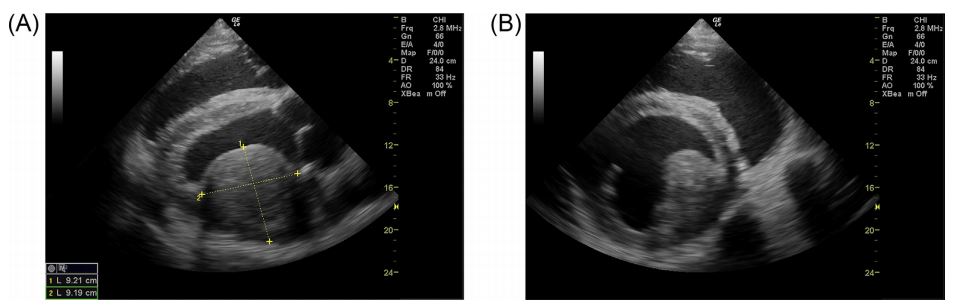Intramural myocardial mass displayed in a right parasternal long axis (A) and short axis (B) view
