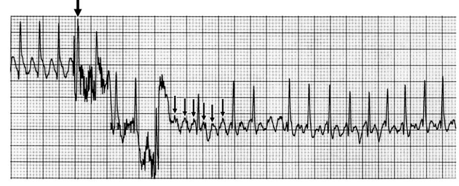 Lead II ECG from case 2 showing transient increased atrioventricular (AV) node block in response to a precordial thump