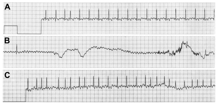 Lead II ECG recorded during episode of syncope in dog from case 2