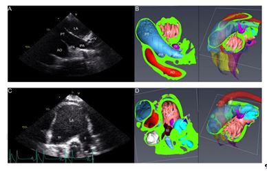 Left parasternal long axis views with echocardiographic (A and C) and corresponding 3D - reconstructed (B and D) images