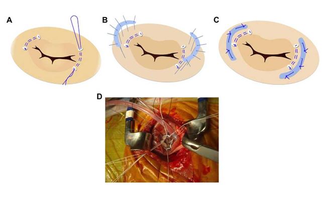 Mitral annuloplasty techniques