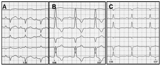 Notice sinus rhythm (176 beats/min) and first-degree atrioventricular block (PR interval: 120 ms)
