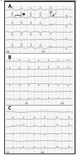 Notice the presence of sinus rhythm (230 beats/ min) with first-degree atrioventricular block (PR interval progressively prolongs from 160 ms to 200 ms
