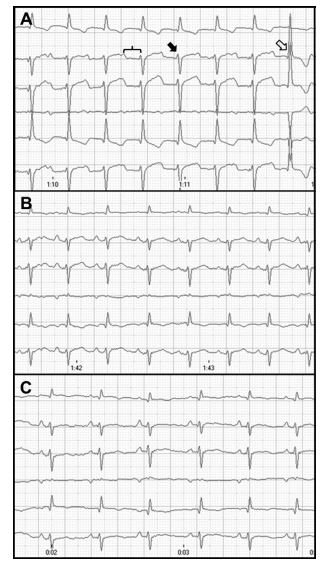 Notice the presence of sinus rhythm with a rate of 180 beats/min conducted with first-degree atrioventricular block (bracket, PR interval: 140 ms)