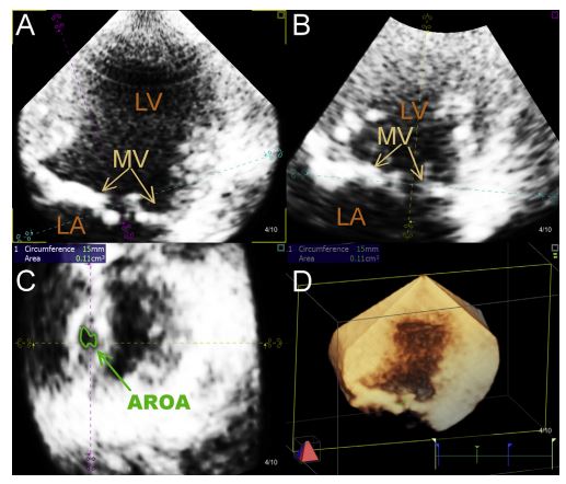 Obtaining the AROA from real-time three-dimensional transthoracic echocardiographic data set