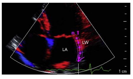 Optimized visualization of the left atrium in a dog with third-degree atrioventricular block and atrial flutter