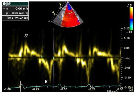Pulsed wave Doppler tissue imaging of the interventricular septum at the level of the mitral annulus