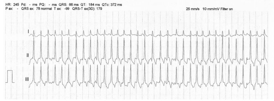 Representative portion of the electrocardiogram at the time of initial evaluation from a dog diagnosed with severe subaortic stenosis