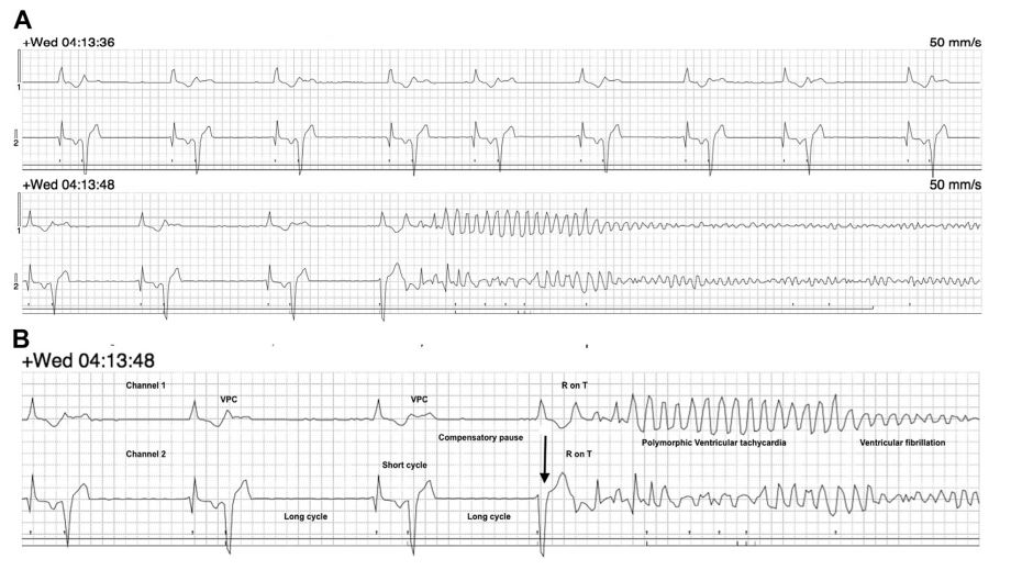 Representative portion of the Holter recording obtained at the time of sudden death from a dog previously diagnosed with severe subaortic stenosis