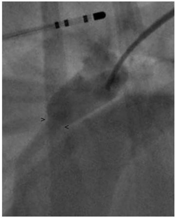 Right lateral angiogram using a reverse Berman angiography catheter with the balloon inflated