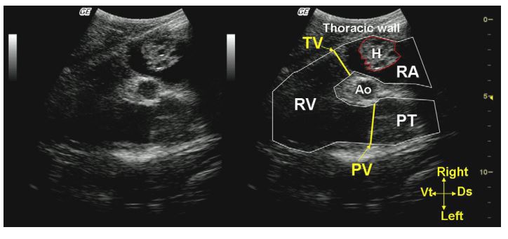 Right long axis view of the right ventricular outflow in the calf