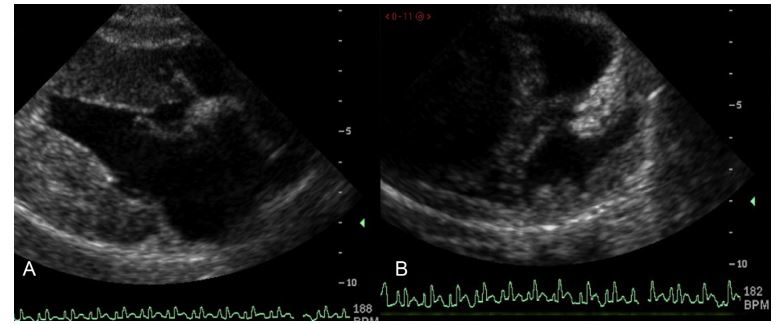 Right parasternal four chamber echocardiographic image recorded at mid-diastole demonstrating marked ventricular wall thickening of mixed echogenicity