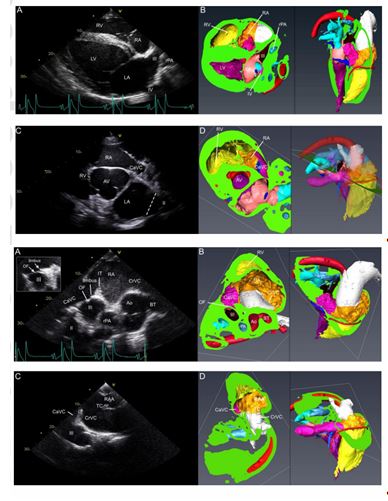 Panels A and B: right parasternal long axis four -chamber view on ultrasound (A) and 3D - reconstructed CT image