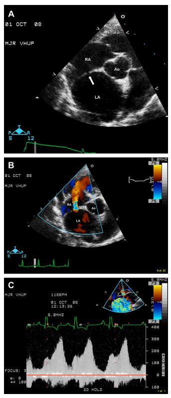 Right parasternal short axis 2-dimensional (A), color Doppler (B), and spectral Doppler (C) echo- cardiographic images at the heart base of dog 1