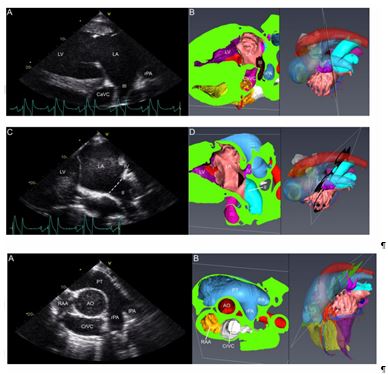 Right parasternal short axis view from the 4th (A) and 3rd (C) intercostal space with corresponding CT images