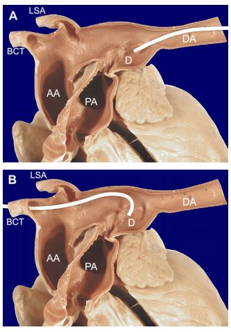 Sagittal section of the great vessels from a dog with congenital PDA showing caudal and cranial catheter approaches to the ductus