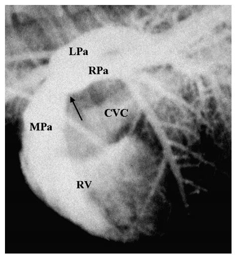 Selective right ventricular angiocardiogram from cat 4 with distal pulmonary artery stenosis