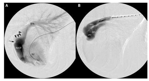 Selective single plane fluoroscopic angiography showing a catheter in the right ventricle