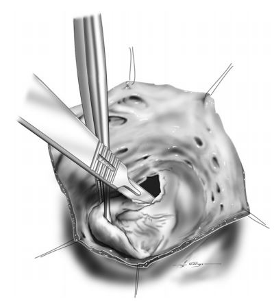 The tricuspid valve leaflets were excised 2—3 mm from the valve annulus