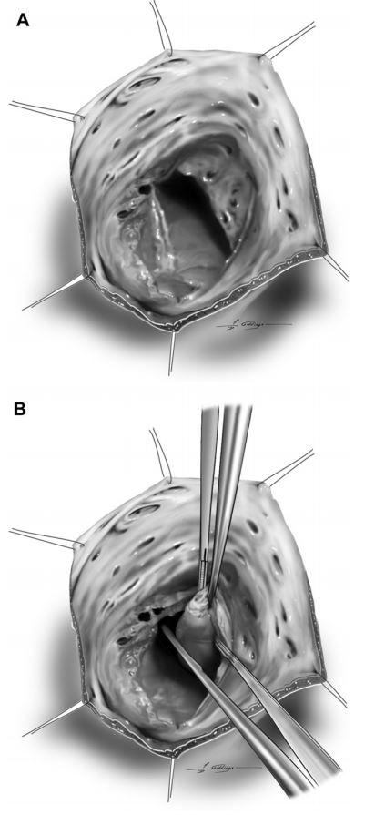 The tricuspid valve was inspected for abnormalities typical of valve dysplasia including tethering of the septal leaflet to the interventricular septum