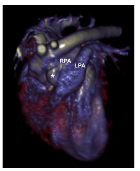 Three-dimensional reconstruction of the heart and great vessels from the contrast-enhanced CT showing the aorta, the anomalous vessel
