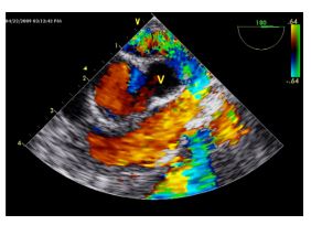 Transesophageal color Doppler echocardiographic image, in the same orientation as Fig.