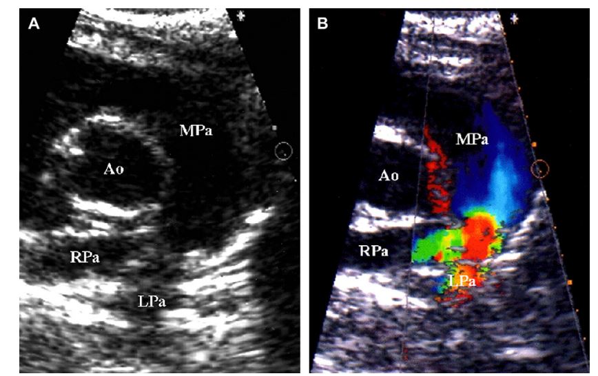 Two-dimensional (A) and color-flow Doppler (B) images of cat 1 with mild pulmonary artery stenosis