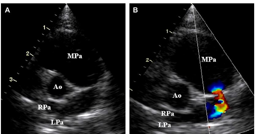 Two-dimensional (A) and color-flow Doppler (B) images of cat 6 with severe pulmonary artery stenosis