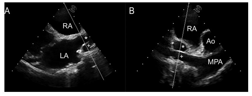 Two-dimensional echocardiographic images of RPV(*) and RPA (+) from (A) the right parasternal long axis view