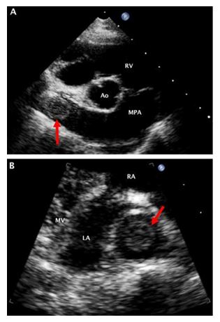 Two-dimensional right parasternal short (A) and long (B) axis echocardiographic images