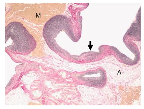 Vascular hamartoma, right atrium. This specific staining enhances elastic fibers in vascular walls (appear in black)