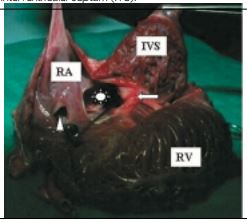 View of the interatrial septum with both ostium primum and secundum septal defects and AV valvular dysplasia